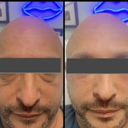 Pineapple Grove Medical Spa - Filler used for tear trough area(eye bags) and erbium laser resurfacing