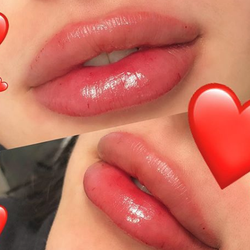 Vienna Skin Clinic - Lips by Tina, RN
