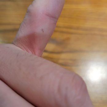 Denny's - The stinger still stuck in my finger and turning red - American Near Me - Fresno, California Denny's - The stinger still stuck in my finger and turning red - American Near Me - Fresno, California
