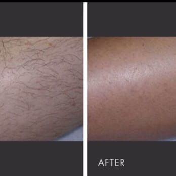 Sabaya Forever Salon - Before & After arms - Laser Hair Removal Near Me - Dearborn, Michigan Sabaya Forever Salon - Before & After arms - Laser Hair Removal Near Me - Dearborn, Michigan