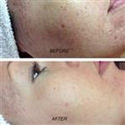 Piel Acne Skin Clinic
