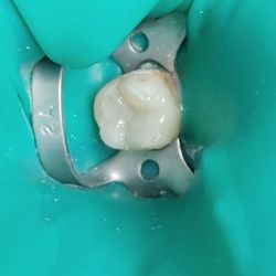 The Happy Tooth - And made it a pretty white tooth again!!