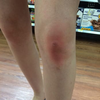 Walmart Supercenter - Busted and bloody, swollen and bruised. Still hurts 10 hours later. - Department Stores Near Me - Denton, Texas
