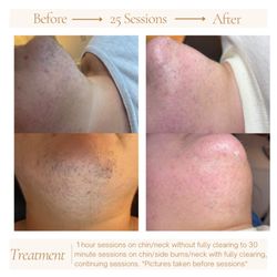 Beach Peach Electrolysis