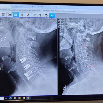 VSI - Before and after great job, Thank you Dr. Jazini - Orthopedists Near Me - Reston, Virginia VSI - Before and after great job, Thank you Dr. Jazini - Orthopedists Near Me - Reston, Virginia