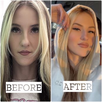 Nurse Tiffany - Before and 3 days after lip filler with Tiffany - Nurse Practitioner Near Me - San Diego, California Nurse Tiffany - Before and 3 days after lip filler with Tiffany - Nurse Practitioner Near Me - San Diego, California