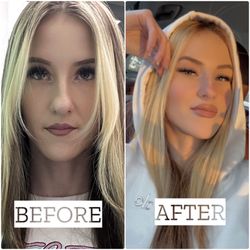 Nurse Tiffany - Before and 3 days after lip filler with Tiffany