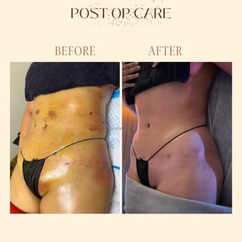 Cuerpo Aesthetics - 3 weeks post op - Body Contouring Near Me - San Mateo, California Cuerpo Aesthetics - 3 weeks post op - Body Contouring Near Me - San Mateo, California