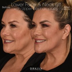 Kian Karimi, MD FACS - Lower Face & Neck Lift with Eyelid Lift performed by Kian Karimi, MD, FACS.