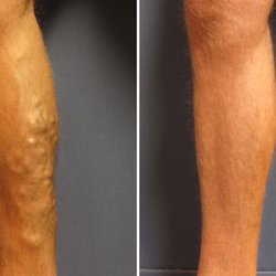 California Vein Specialists