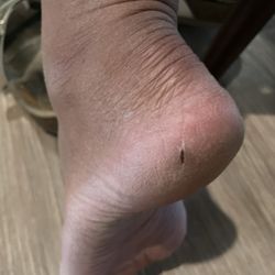 Lavish Nail - A week after doing feet, both feet scrubbed raw and bleeding :( now they are bruised and I am having such a hard time walking