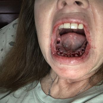Aspen Dental - Lexington, SC - Huge hole and stitches - Oral Surgeons Near Me - Lexington, South Carolina