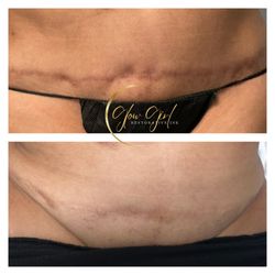 Restorative Ink by Rebecca Matthews - Tummy Tuck Scar Revision