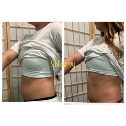 Solkurvy - 3 inches lost in 1 session... (Ultrasound cavitation,RF and laser lipo)