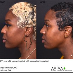 Aviva Plastic Surgery & Aesthetics - Nonsurgical rhinoplasty provides a way to reshape the nose without the downtime of surgery.