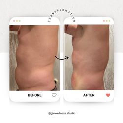 GLO Wellness Studio - CryoSlimming 2 treatments