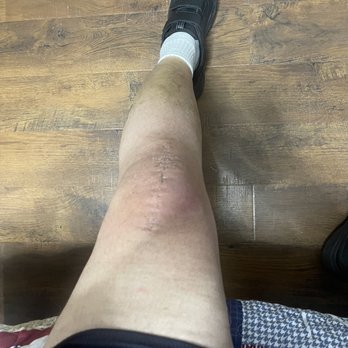 Advantage Orthopedic & Sports Medicine - 1 month after surgery - Sports Medicine Near Me - Gresham, Oregon Advantage Orthopedic & Sports Medicine - 1 month after surgery - Sports Medicine Near Me - Gresham, Oregon