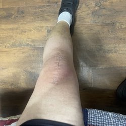 Advantage Orthopedic & Sports Medicine - 1 month after surgery