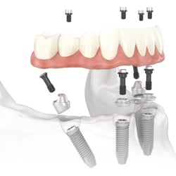 Western Pennsylvania Oral & Maxillofacial Surgery - Dental implants to replace an entire arch of teeth.