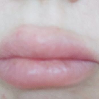Renu 180 Medspa - Painful botched lip injection - Medical Spas Near Me - Southington, Connecticut Renu 180 Medspa - Painful botched lip injection - Medical Spas Near Me - Southington, Connecticut