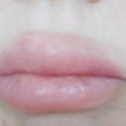 Renu  180  Medspa - Painful botched lip injection