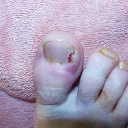 Foot and Ankle Institute of NC - I treat ingrown nail with same day appointments and you are able to go right back to