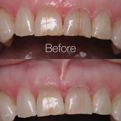 Kevin Shearer, DDS - This patient had a stained enamel crack on one of her front teeth, so we cleaned out the crack and fixed the chipped edge as well.