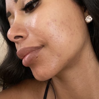 Solutions Skin Care By Kimberly - My skin starting to looks slightly better after beginning my treatments. - Skin Care Near Me - Costa Mesa, California