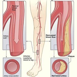 Champion Vascular Care