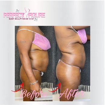 Perfect Figure Body Sculpting - Client first session of the mommy makeover special and butt enhancement - Body Contouring Near Me Perfect Figure Body Sculpting - Client first session of the mommy makeover special and butt enhancement - Body Contouring Near Me