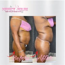 Perfect Figure Body Sculpting - Client first session of the mommy makeover special and butt enhancement