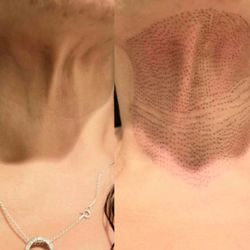 True Beauty Skin Tightening