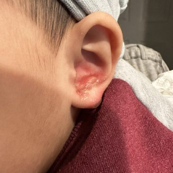 Lighthouse Pediatrics - Look at the intense redness and the blister form on his ear. - Pediatricians Near Me - Torrance, California Lighthouse Pediatrics - Look at the intense redness and the blister form on his ear. - Pediatricians Near Me - Torrance, California