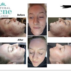 Natural Skincare Clinic - Finally got my before and after pictures today! Took awhile to get these - surprising because I think my results were incredible!