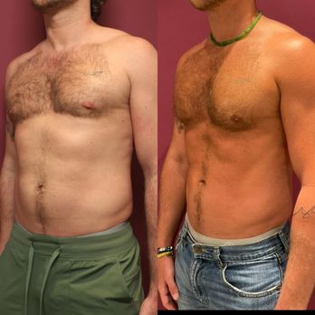 Walter J Joseph, MD - Minimal incision Umbilical
Hernia Repair, Liposuction of the abdomen and flanks - Plastic Surgeons Near Me - Beverly Hills, California Walter J Joseph, MD - Minimal incision Umbilical
Hernia Repair, Liposuction of the abdomen and flanks - Plastic Surgeons Near Me - Beverly Hills, California