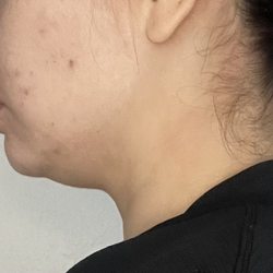 LipoSculp - Before Double-Chin Removal