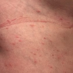 Anker Hostel - Bed bug bites literally covering most of my body.