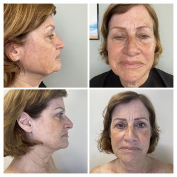 Indulgence Cosmetics & Skincare - Ultherapy treatment for the lower face & neck is specifically designed to address sagging skin & wrinkles - Skin Care Near Me - Danville, California Indulgence Cosmetics & Skincare - Ultherapy treatment for the lower face & neck is specifically designed to address sagging skin & wrinkles - Skin Care Near Me - Danville, California
