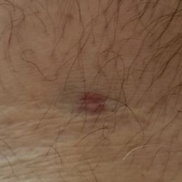 Very small bruise, at least for now.
