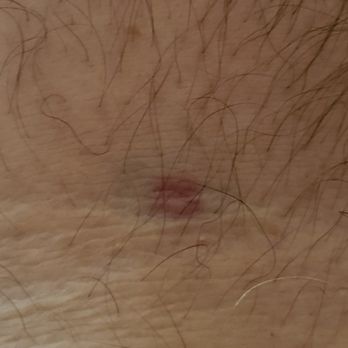 Quest Diagnostics - Very small bruise, at least for now. - Laboratory Testing Near Me - Sun City, California