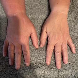 Arizona State Orthopaedics: George Myo, M.D - Swelling