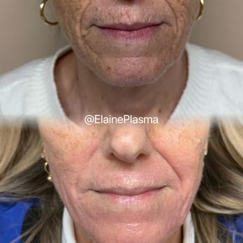La Beauty Spa - Lower face lift with non invasive treatment plasma fibroblast! - Nail Salons Near Me - Burlington , Massachusetts La Beauty Spa - Lower face lift with non invasive treatment plasma fibroblast! - Nail Salons Near Me - Burlington , Massachusetts
