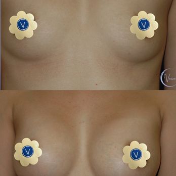 Verve Plastic Surgery - Breast Augmentation - Cosmetic Surgeons Near Me - Encinitas, California Verve Plastic Surgery - Breast Augmentation - Cosmetic Surgeons Near Me - Encinitas, California