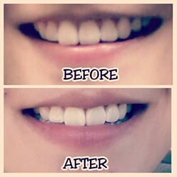 Rick Larson, DDS - Got whitening done for my birthday present to myself! Sucks I didn't take a picture of my teeth just before I whitened!