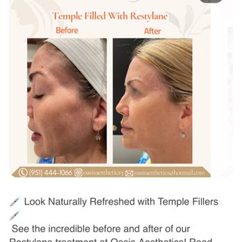 Oasis Aesthetics - Temple filled - Weight Loss Centers Near Me - Riverside, California Oasis Aesthetics - Temple filled - Weight Loss Centers Near Me - Riverside, California