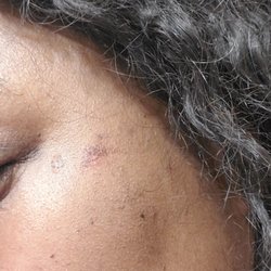 Simplicity Laser Hair Removal - Burn marks near eye