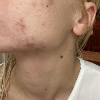 Acne Clinic NYC - Skin Care Near Me - New York, New York Acne Clinic NYC - Skin Care Near Me - New York, New York