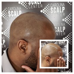 Carolina Scalp Center/Scalp Micropigmentation - Carolina Scalp Center can give you a clean cut look that will last for years!