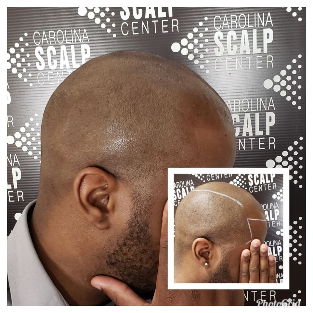 CAROLINA SCALP CENTER/SCALP MICROPIGMENTATION Updated September 2024