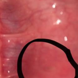 Absolute Ink - Inflamed inside of 1st lip piercing